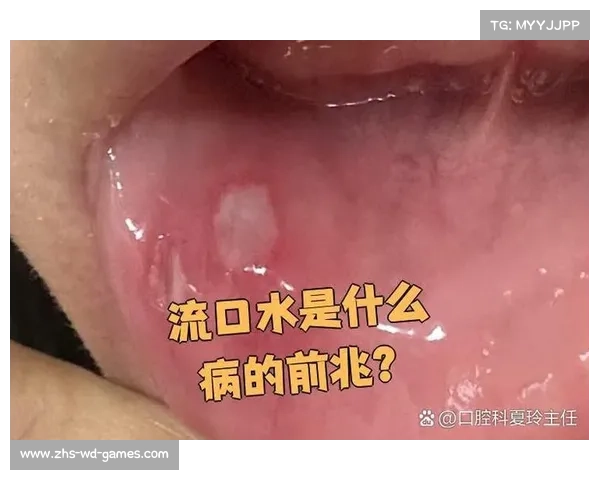 舌头口腔溃疡引起口水增多的原因及应对方法解析 舌头口腔溃疡引起口水增多的原因及应对方法解析